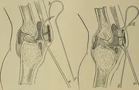 An illustration from Modern surgery, general and operative / by John Chalmers DaCosta. (1914)