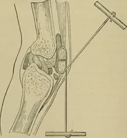 An illustration from Modern surgery, general and operative / by John Chalmers DaCosta. (1914)