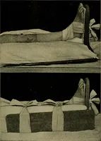 An illustration from Modern surgery, general and operative / by John Chalmers DaCosta. (1914)