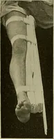 An illustration from Modern surgery, general and operative / by John Chalmers DaCosta. (1914)
