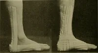 An illustration from Modern surgery, general and operative / by John Chalmers DaCosta. (1914)