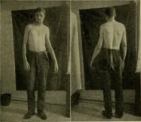 An illustration from Modern surgery, general and operative / by John Chalmers DaCosta. (1914)
