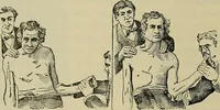 An illustration from Modern surgery, general and operative / by John Chalmers DaCosta. (1914)