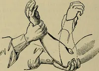 An illustration from Modern surgery, general and operative / by John Chalmers DaCosta. (1914)