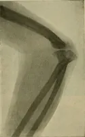 An illustration from Modern surgery, general and operative / by John Chalmers DaCosta. (1914)