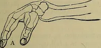 An illustration from Modern surgery, general and operative / by John Chalmers DaCosta. (1914)