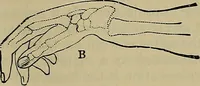 An illustration from Modern surgery, general and operative / by John Chalmers DaCosta. (1914)