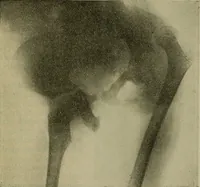 An illustration from Modern surgery, general and operative / by John Chalmers DaCosta. (1914)