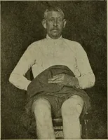 An illustration from Modern surgery, general and operative / by John Chalmers DaCosta. (1914)