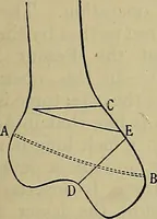 An illustration from Modern surgery, general and operative / by John Chalmers DaCosta. (1914)