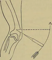 An illustration from Modern surgery, general and operative / by John Chalmers DaCosta. (1914)