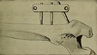 An illustration from Modern surgery, general and operative / by John Chalmers DaCosta. (1914)