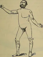 An illustration from Modern surgery, general and operative / by John Chalmers DaCosta. (1914)