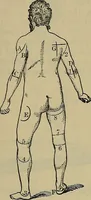 An illustration from Modern surgery, general and operative / by John Chalmers DaCosta. (1914)