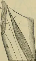 An illustration from Modern surgery, general and operative / by John Chalmers DaCosta. (1914)
