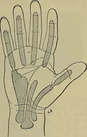 An illustration from Modern surgery, general and operative / by John Chalmers DaCosta. (1914)
