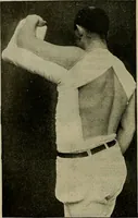 An illustration from Modern surgery, general and operative / by John Chalmers DaCosta. (1914)