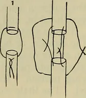 An illustration from Modern surgery, general and operative / by John Chalmers DaCosta. (1914)