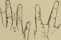 An illustration from Modern surgery, general and operative / by John Chalmers DaCosta. (1914)