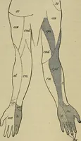 An illustration from Modern surgery, general and operative / by John Chalmers DaCosta. (1914)