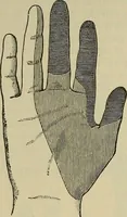 An illustration from Modern surgery, general and operative / by John Chalmers DaCosta. (1914)