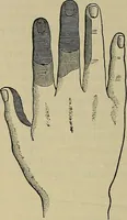An illustration from Modern surgery, general and operative / by John Chalmers DaCosta. (1914)