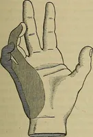 An illustration from Modern surgery, general and operative / by John Chalmers DaCosta. (1914)
