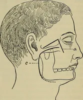 An illustration from Modern surgery, general and operative / by John Chalmers DaCosta. (1914)