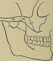 An illustration from Modern surgery, general and operative / by John Chalmers DaCosta. (1914)