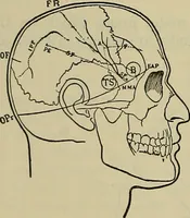 An illustration from Modern surgery, general and operative / by John Chalmers DaCosta. (1914)