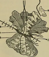 An illustration from Modern surgery, general and operative / by John Chalmers DaCosta. (1914)