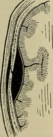 An illustration from Modern surgery, general and operative / by John Chalmers DaCosta. (1914)