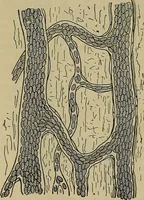 An illustration from Modern surgery, general and operative / by John Chalmers DaCosta. (1914)