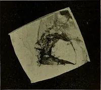 An illustration from Modern surgery, general and operative / by John Chalmers DaCosta. (1914)
