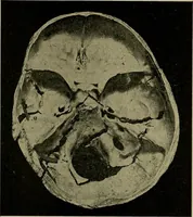 An illustration from Modern surgery, general and operative / by John Chalmers DaCosta. (1914)