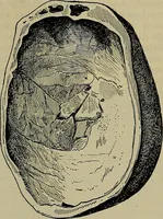 An illustration from Modern surgery, general and operative / by John Chalmers DaCosta. (1914)