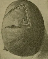 An illustration from Modern surgery, general and operative / by John Chalmers DaCosta. (1914)
