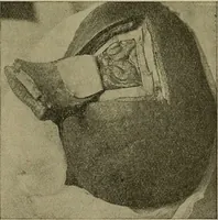 An illustration from Modern surgery, general and operative / by John Chalmers DaCosta. (1914)