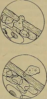 An illustration from Modern surgery, general and operative / by John Chalmers DaCosta. (1914)