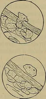 An illustration from Modern surgery, general and operative / by John Chalmers DaCosta. (1914)
