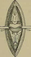 An illustration from Modern surgery, general and operative / by John Chalmers DaCosta. (1914)