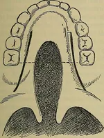 An illustration from Modern surgery, general and operative / by John Chalmers DaCosta. (1914)