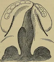 An illustration from Modern surgery, general and operative / by John Chalmers DaCosta. (1914)