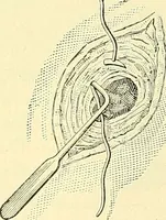 Picture 351 of 481 from Modern surgery, general and operative / by John Chalmers Da Costa. (1907), leaf 1003