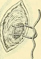 Picture 352 of 481 from Modern surgery, general and operative / by John Chalmers Da Costa. (1907), leaf 1003