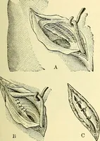Picture 353 of 481 from Modern surgery, general and operative / by John Chalmers Da Costa. (1907), leaf 1005