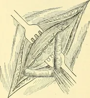Picture 354 of 481 from Modern surgery, general and operative / by John Chalmers Da Costa. (1907), leaf 1005