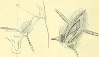 Picture 355 of 481 from Modern surgery, general and operative / by John Chalmers Da Costa. (1907), leaf 1006