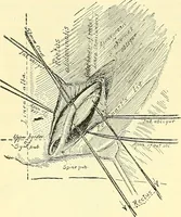 Picture 357 of 481 from Modern surgery, general and operative / by John Chalmers Da Costa. (1907), leaf 1008