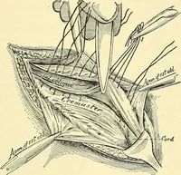 An illustration from Modern surgery, general and operative / by John Chalmers Da Costa. (1907)